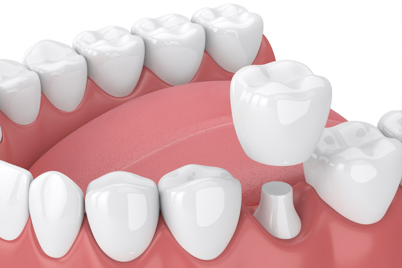 Dental Crowns in Denver