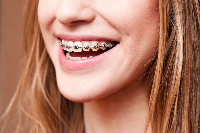 Orthodontics in Denver