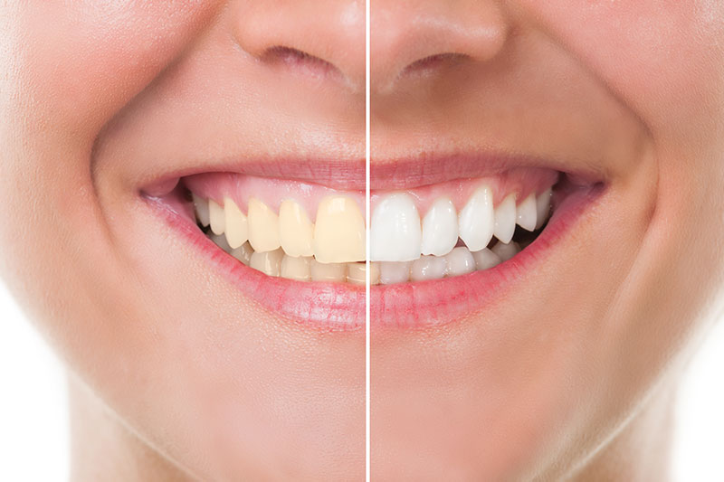 Teeth Whitening in Denver